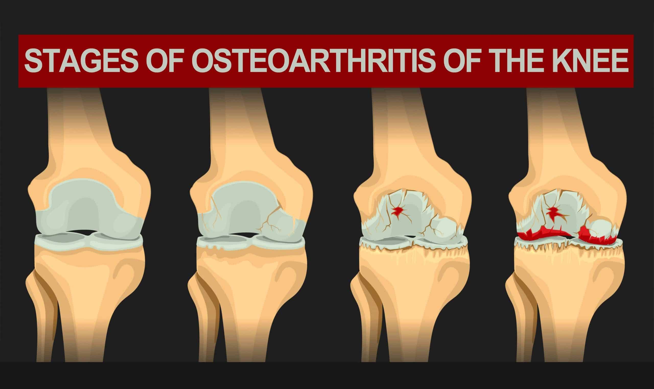 Knee Osteoarthritis: Are You Feeling the Effects of Wear and Tear